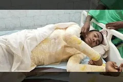 Morre menino cristão que teve 65% do corpo queimado em ataque