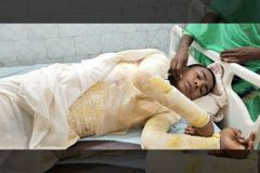 Menino que teve 65% do corpo queimado em ataque tem pouca chance de sobreviver, diz médico