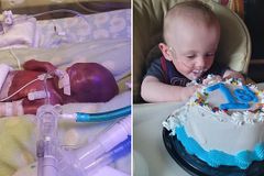 Reconhecido como "milagre", bebê mais prematuro do mundo completa 1 ano de idade