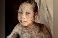 Família sofre ataque com ácido por deixar islã e se converter a Jesus