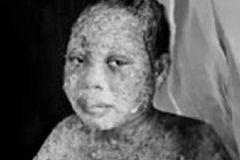 Família sofre ataque com ácido por deixar o Islã e aceitar a Jesus Cristo