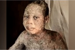 Pai, esposa e filha cristãos são atacados com ácido por muçulmanos