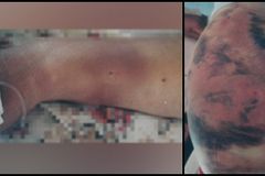 Cristãos mostram marcas de torturas realizadas em prisões comunistas, na China