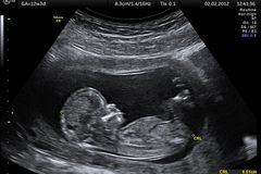 Ministério Público pede uso de anestesia em bebês abortados com cloreto de potássio