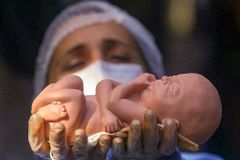MP reconhece que o aborto é tortura para o bebê e pede anestesia