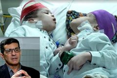 'Quando tem 1% de chance, tem 99% de fé', diz médico que fez cirurgia de gêmeos siameses