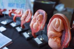 Aborto foi a principal causa de morte em 2018, tirando 41 milhões de vidas inocentes | Notícias Gospel