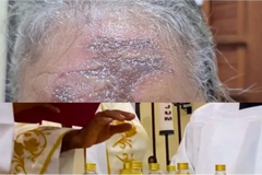 Católicos apresentam queimadura após unção com óleo em missa