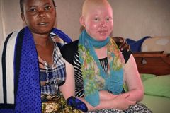 Bruxos matam crianças albinas para usar partes de seus corpos, na Tanzânia