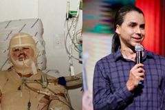 Homem desenganado com 40% do corpo queimado sobrevive: “Estou vivo para glória de Deus”