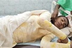 Christian Boy, 14, Clinging to Life after Burn Attack in Eastern India - Morningstar News