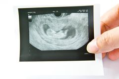 Supreme Court Allows Texas Bill Banning Abortions Once a Heartbeat is Detected to Remain in Place