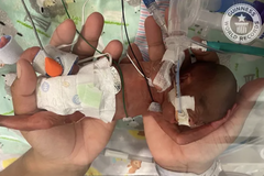 World's most premature baby was born 3 weeks before UK abortion limit