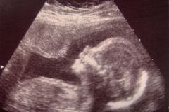Abortion providers adjust to new federal funding rules | Baptist Press