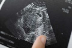 Heartbeat abortion bans move forward in Tennessee, Georgia