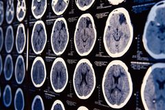 In First, Israeli Scientists Engineer Spinal Cord Implants to Treat Paralysis