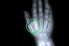 British Microchip Implant Takes Hand-Swipe Payments to Next Level, Along with End Times Prophecy Concerns