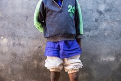 How we can kick Clubfoot for good