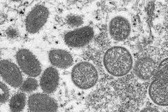 Monkeypox in over half of U.S. states