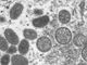 Monkeypox in over half of U.S. states