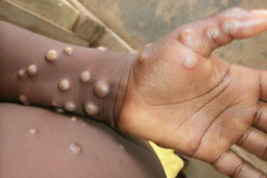 As Monkeypox Spreads, Global Organizations Mobilize Faith Networks To Fight Stigma