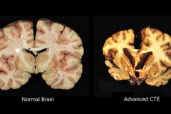 'No Safe Blow to the Head': Why One Season of Childhood Football Likely Means Irreversible Brain Damage