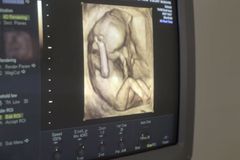 NPR Blatantly Denies Unborn Child's Humanity to Justify LIVE Abortion Broadcast