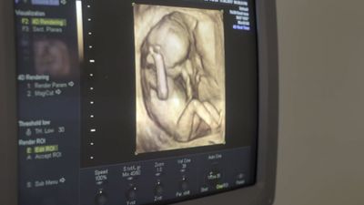 NPR Blatantly Denies Unborn Child's Humanity to Justify LIVE Abortion Broadcast