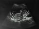 Abortion clinic buffer zones are 'illiberal and cruel'