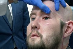 Surgeons perform world’s first eye transplant