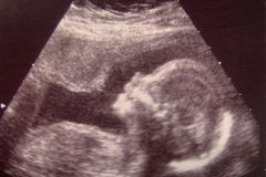 Texas defends dismemberment abortion ban | Baptist Press
