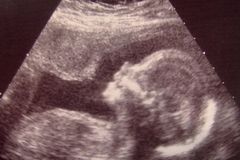 Ky. bills to protect unborn babies progress | Baptist Press