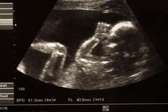 Britain to Vote on Decriminalizing Abortion