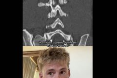 Forrest Frank shows proof of broken back, rapid healing: 'Did we see a miracle?'