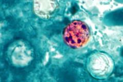 Michigan outbreak of parasitic infection sickens more than 1,200