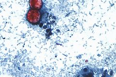 Two Michigan deaths first of multistate cyclospora outbreak