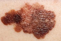 Melanoma vaccine success sparks hope for broader cancer treatment