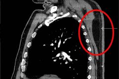 [건강 돋보기] 등에 구슬만한 멍울이 아기 주먹 만큼 커졌는데…혹시 암?