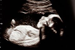 아들 원했던 동성 커플, 실수로 딸 출산 후 불임 클리닉 고소