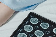 [백석균의 건강칼럼] 암 환자는 항암치료나 과잉 진료로 죽는다