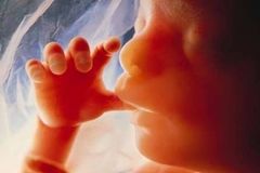 2025년 전 세계 낙태 7,300만 건… 7년 연속 사망 원인 1위