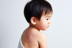 환절기 소아 아토피피부염, 가려움·긁기 악순환 주의… 보습·치료 병행해야