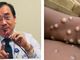 Eksperto, nagbabala sa epekto ng ‘monkeypox’